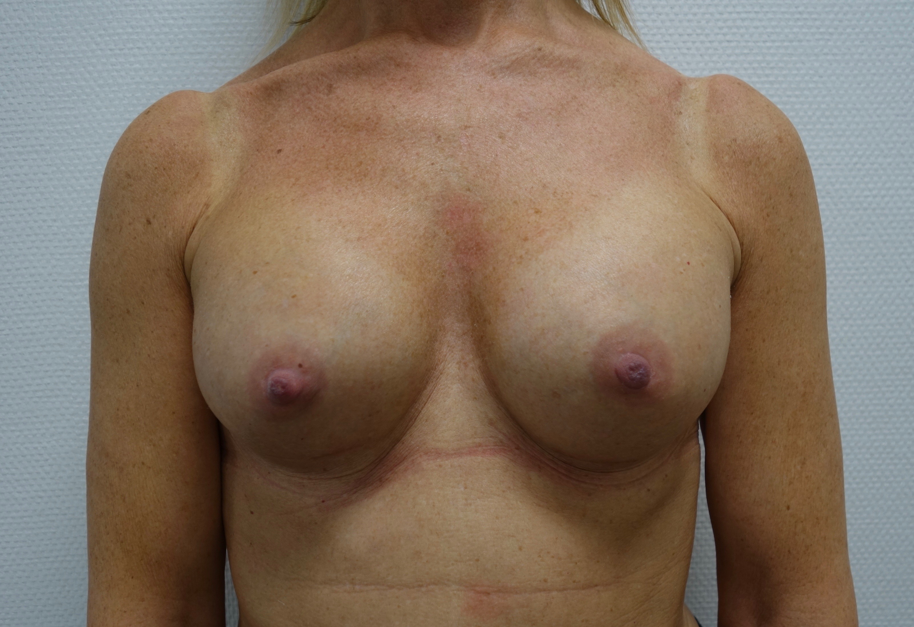 Fotos Antes y Después