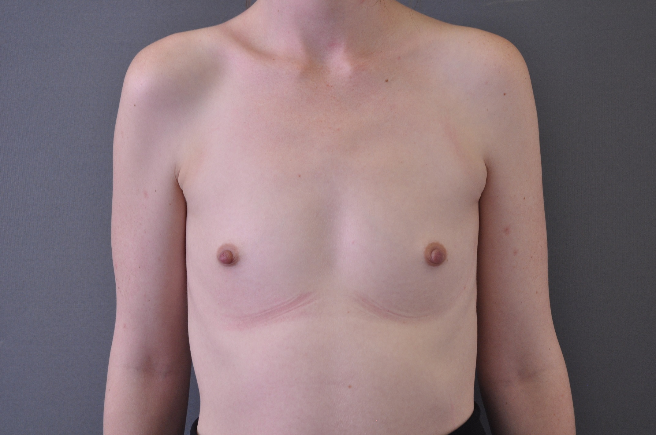 Önce ve sonra resimleri