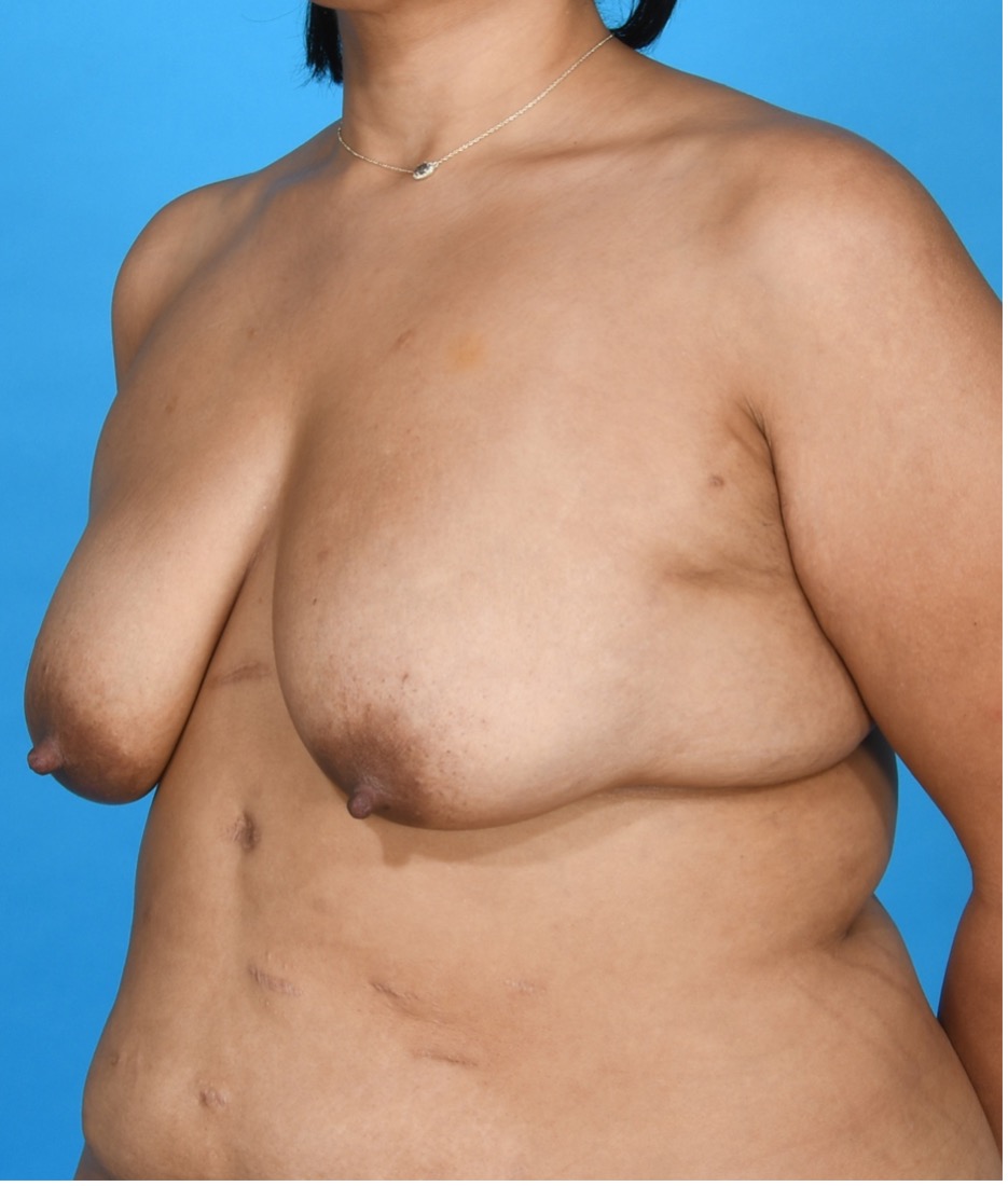 ภาพก่อนและหลัง