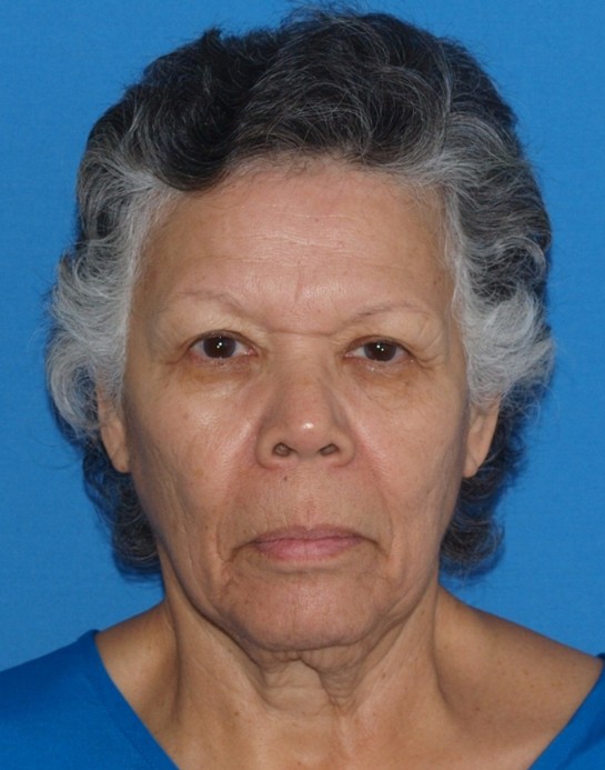 Vorher-Nachher-Bilder