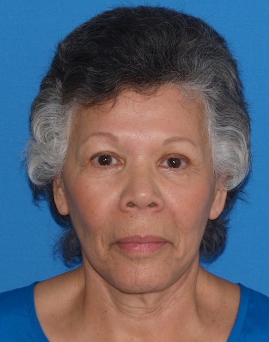 Vorher-Nachher-Bilder