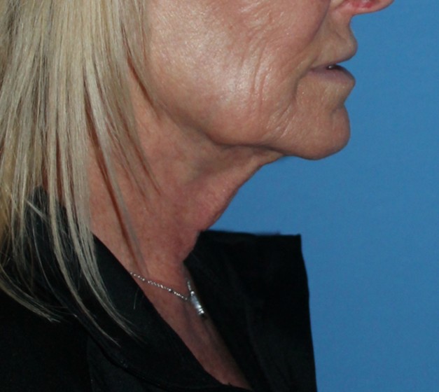 Vorher-Nachher-Bilder