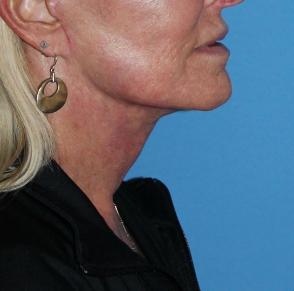 Vorher-Nachher-Bilder