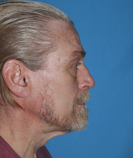 Vorher-Nachher-Bilder