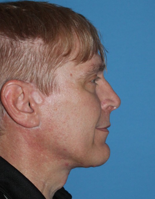 Vorher-Nachher-Bilder