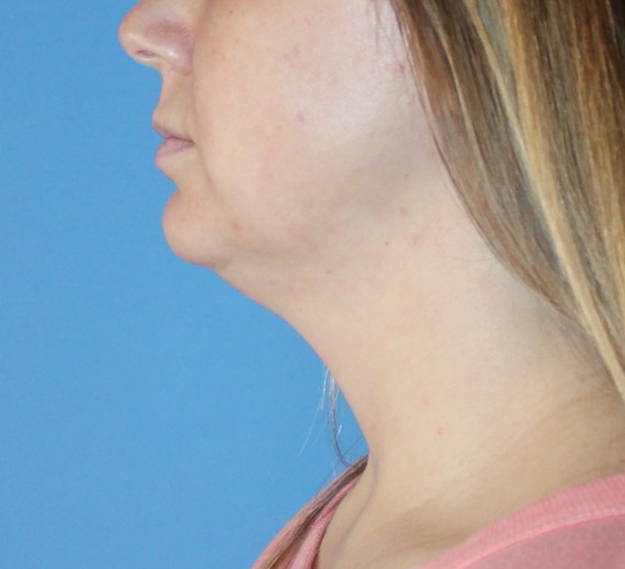 Vorher-Nachher-Bilder