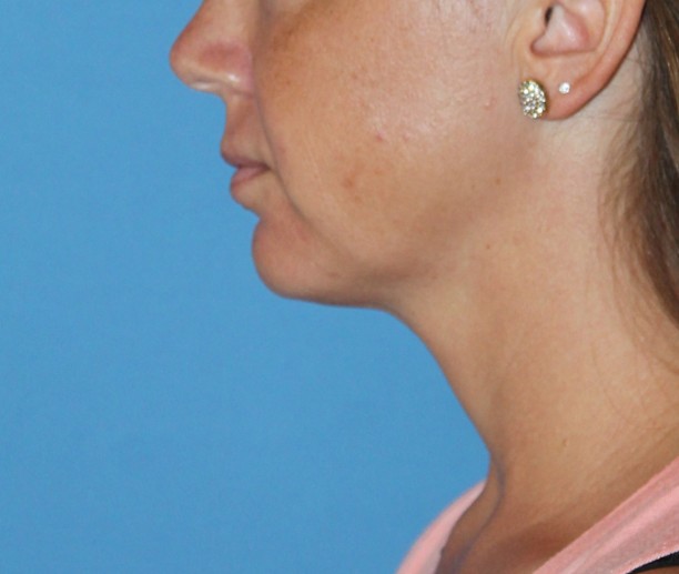 Vorher-Nachher-Bilder